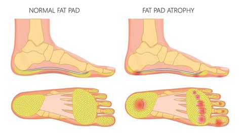 What Are Fat Pads?